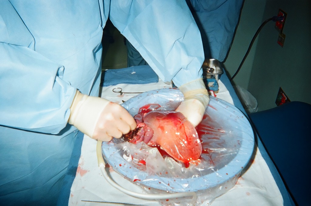 07_Parms_Left_Lobe_1