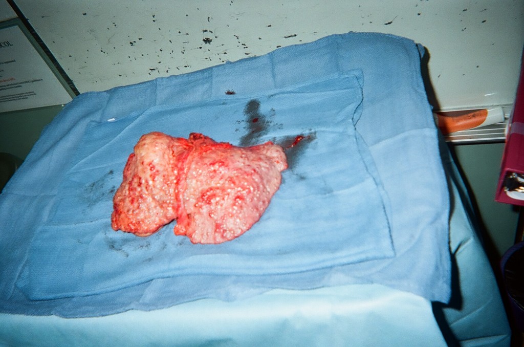 09_Diseased_Liver_removed_1