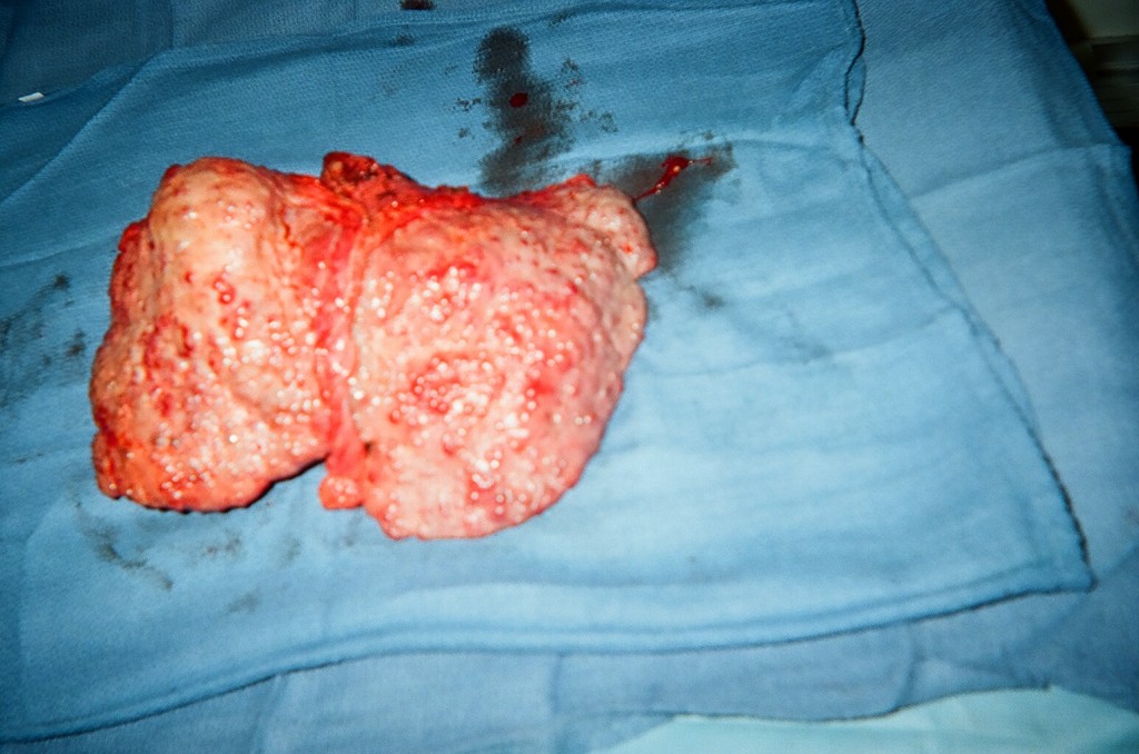 10_Diseased_Liver_removed_2